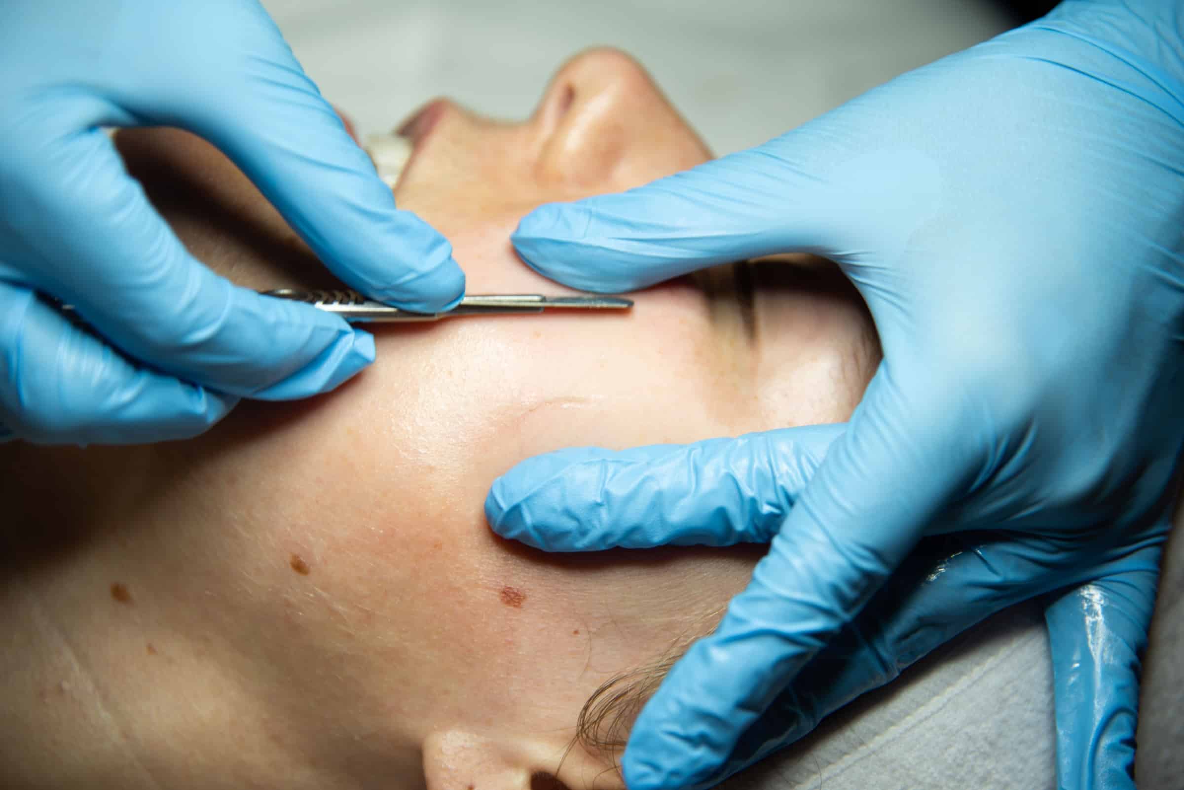 A close-up of a person's face during a skincare treatment, with a professional wearing blue gloves holding a surgical tool near the forehead. The background is blurred to emphasize the treatment process.