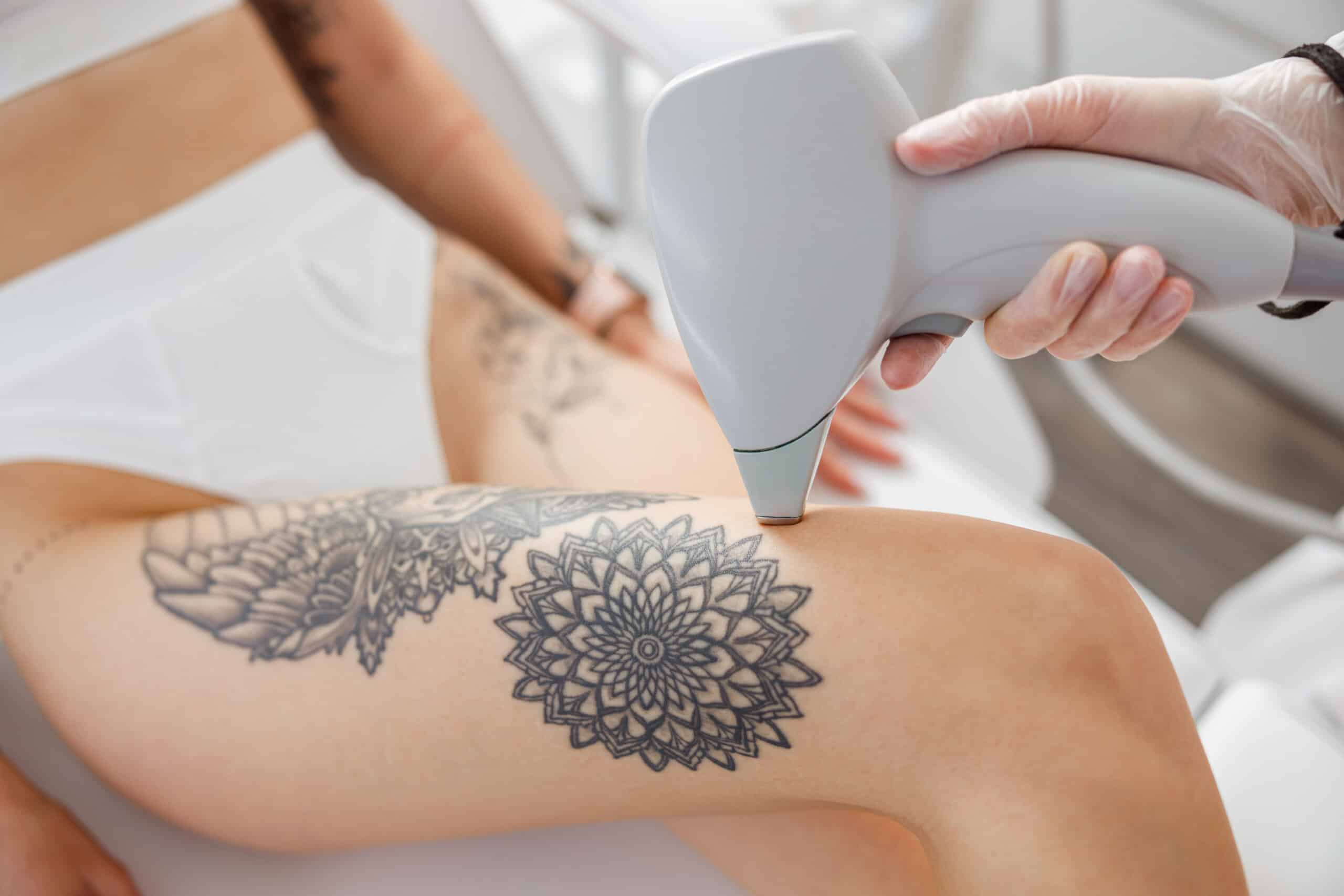 A close-up view of a person's thigh displaying a detailed black tattoo of flowers, while a hand holds a laser removal device pointing towards the tattoo. The person is seated, and their leg is partially covered with a white garment.