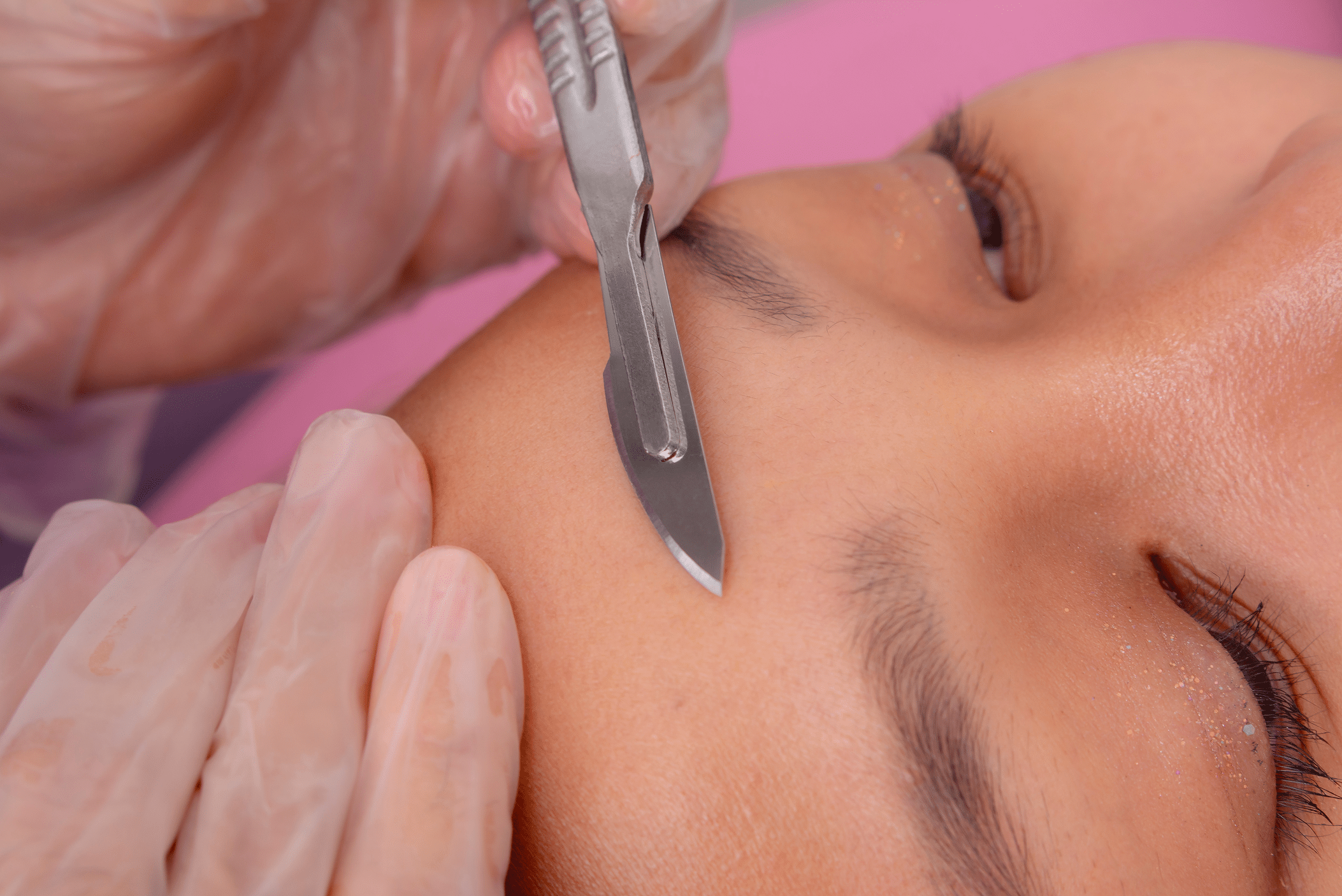 A close-up view of a person receiving a facial treatment. A gloved hand holds a small surgical blade near the side of the individual's face, focusing on the area above the eyebrow, while the background features a soft pink surface.